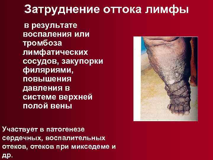 Затруднение оттока лимфы в результате воспаления или тромбоза лимфатических сосудов, закупорки филяриями, повышения давления
