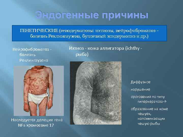 Эндогенные причины ГЕНЕТИЧЕСКИЕ (генодерматозы: ихтиозы, нейрофиброматоз – болезнь Реклингаузена, буллезный эпидермолиз и др. )