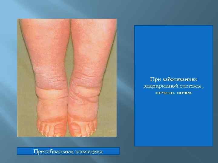 При заболеваниях эндокринной системы , печени. почек Претибиальная микседема 