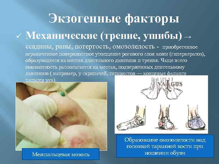  Экзогенные факторы ü Механические (трение, ушибы) → ссадины, раны, потертость, омозолелость - приобретенное