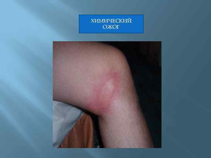 ХИМИЧЕСКИЙ ОЖОГ 