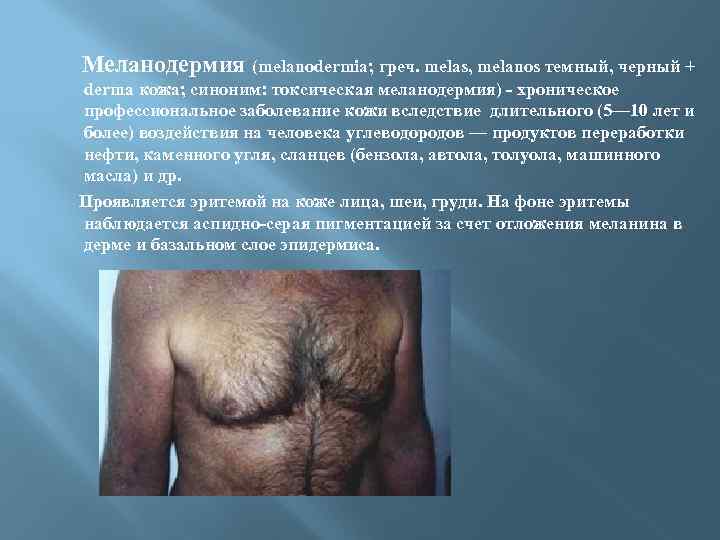  Меланодермия (melanodermia; греч. melas, melanos темный, черный + derma кожа; синоним: токсическая меланодермия)