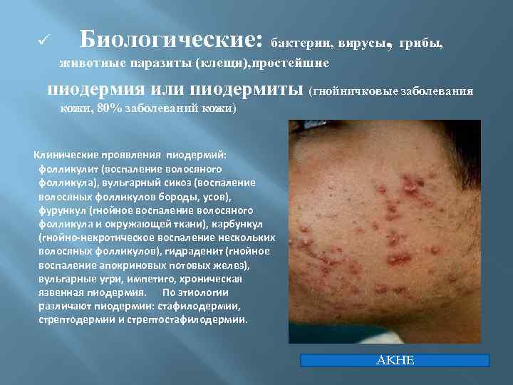 ü Биологические: бактерии, вирусы, грибы, животные паразиты (клещи), простейшие пиодермия или пиодермиты (гнойничковые заболевания