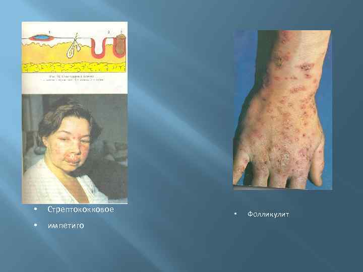  • Стрептококковое • импетиго • Фолликулит 