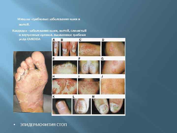 Микозы –грибковые заболевания кожи и ногтей. Кандидоз –заболевания кожи, ногтей, слизистый и внутренных органов,