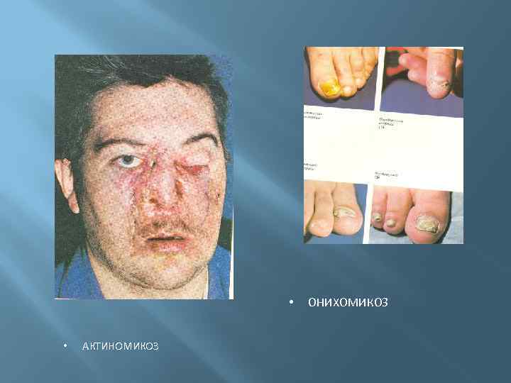  • • АКТИНОМИКОЗ ОНИХОМИКОЗ 