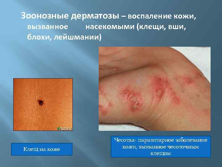 Зоонозные дерматозы – воспаление кожи, вызванное насекомыми (клещи, вши, блохи, лейшмании) Клещ на коже