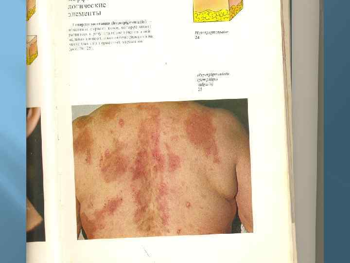 Пигментные пятна 