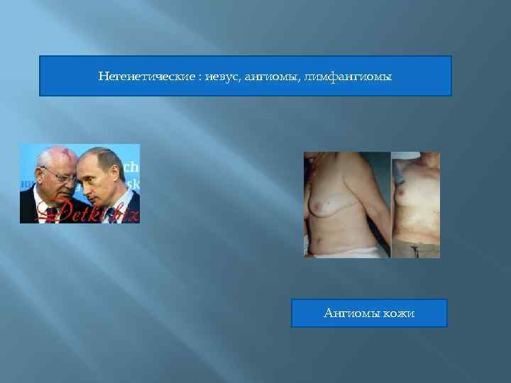 Негенетические : невус, ангиомы, лимфангиомы Ангиомы кожи 