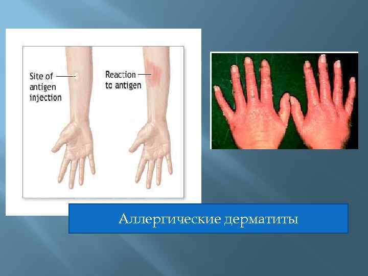 Аллергические дерматиты 