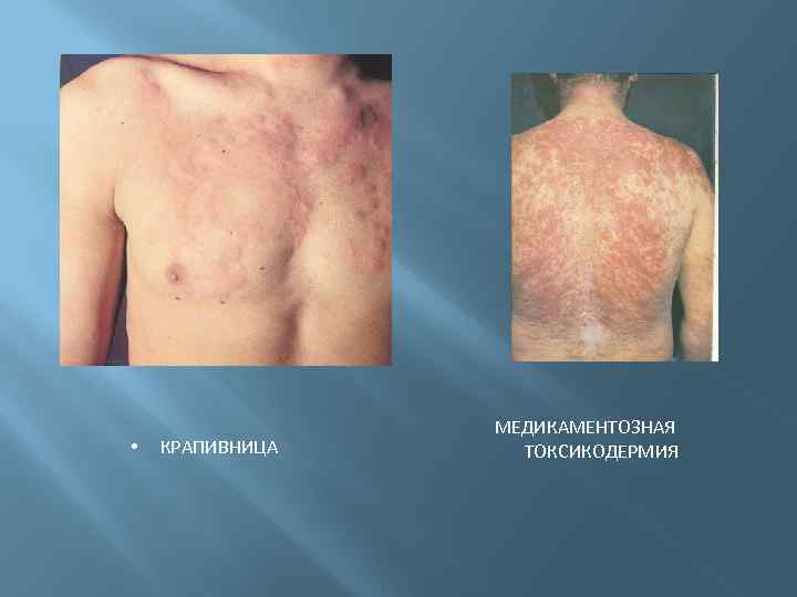  • КРАПИВНИЦА МЕДИКАМЕНТОЗНАЯ ТОКСИКОДЕРМИЯ 