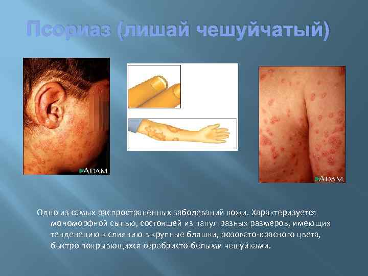 Псориаз (лишай чешуйчатый) Одно из самых распространенных заболеваний кожи. Характеризуется мономорфной сыпью, состоящей из