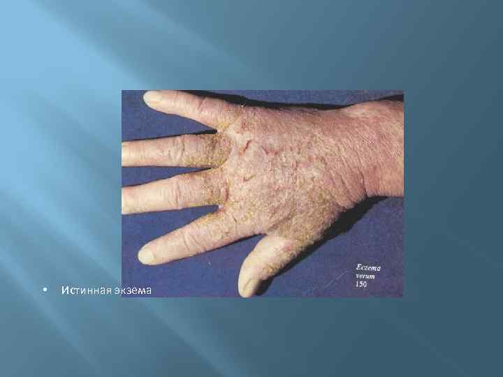  • Истинная экзема 
