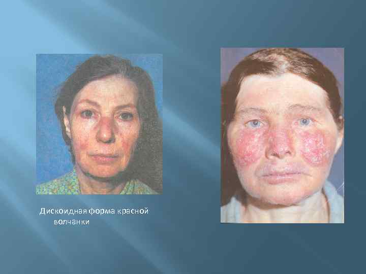 Дискоидная форма красной волчанки 