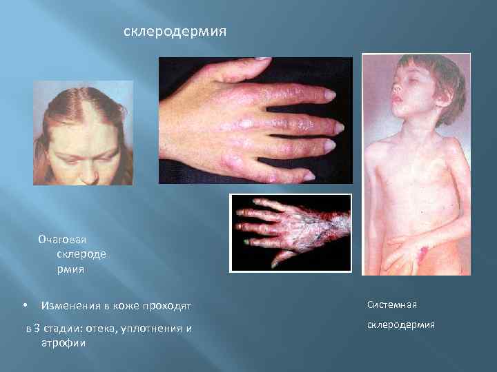склеродермия Очаговая склероде рмия • Изменения в коже проходят в 3 стадии: отека, уплотнения