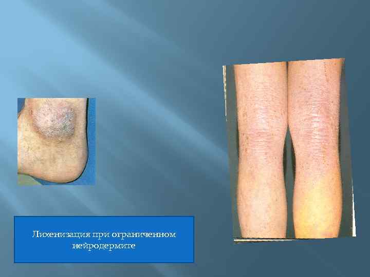 Лихенизация при ограниченном нейродермите 