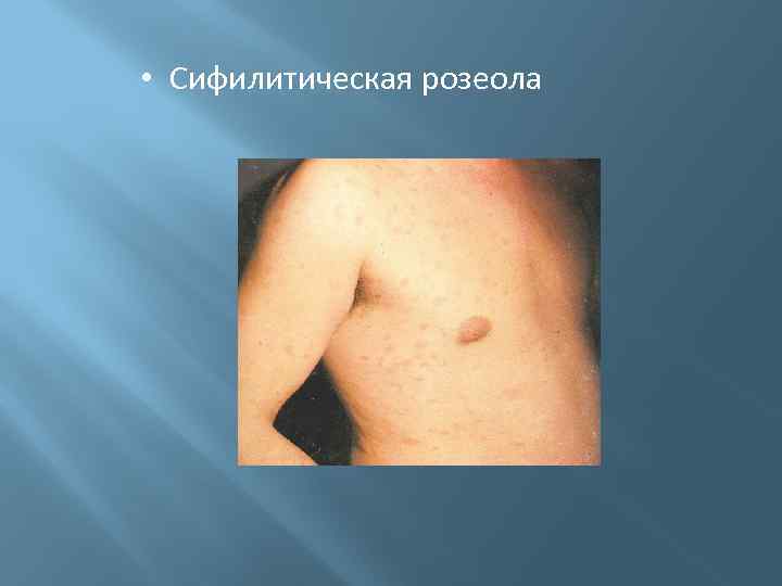  • Сифилитическая розеола 