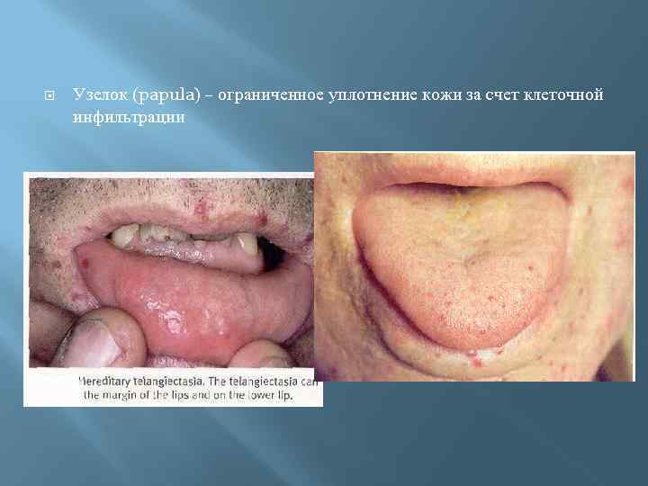  Узелок (papula) – ограниченное уплотнение кожи за счет клеточной инфильтрации 