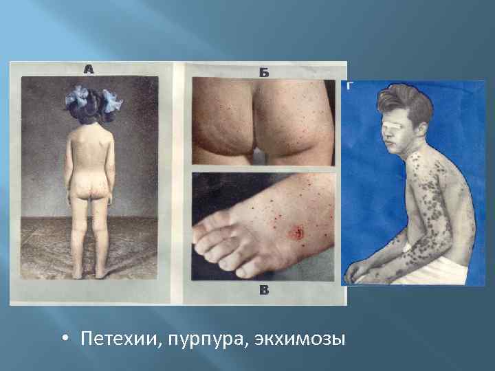  • Петехии, пурпура, экхимозы 