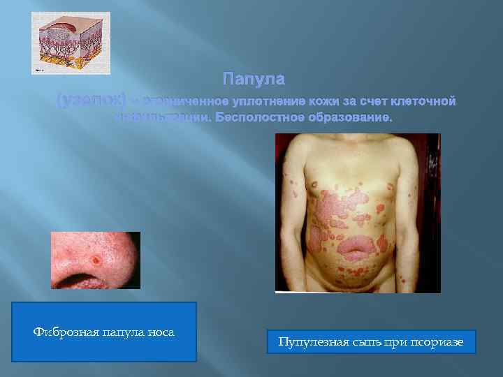 Папула (узелок) - ограниченное уплотнение кожи за счет клеточной инфильтрации. Бесполостное образование. Фиброзная папула
