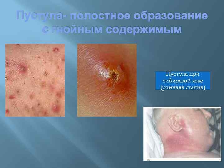 Пустула- полостное образование с гнойным содержимым Пустула при сибирской язве (ранняяя стадия) 