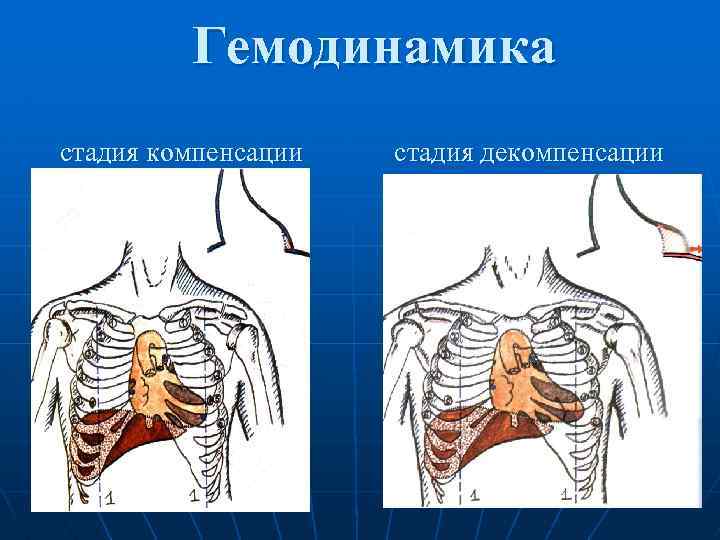 Отрыв хорды трикуспидального клапана