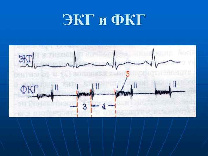 ЭКГ и ФКГ 