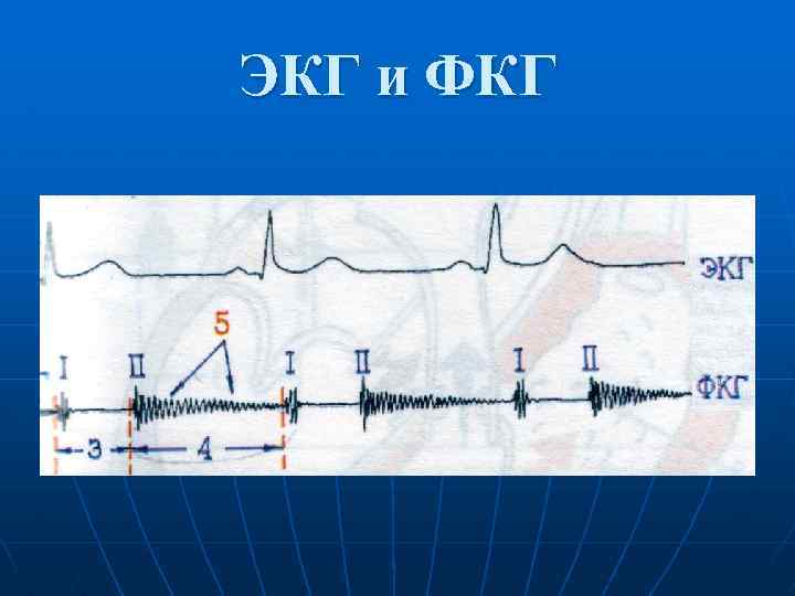 ЭКГ и ФКГ 