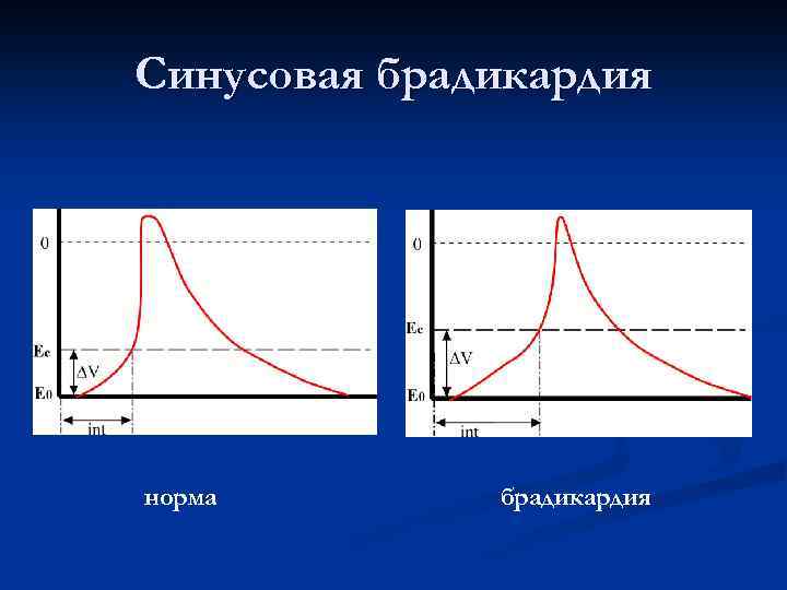 Синусовая брадикардия норма брадикардия 