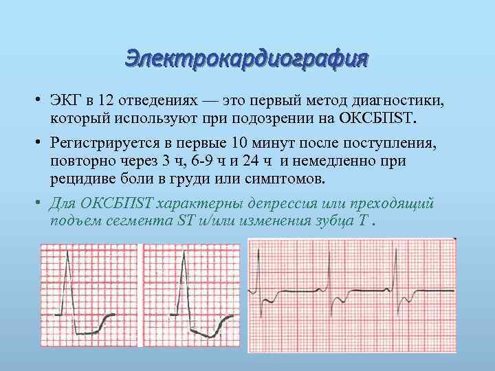 Электрокардиография • ЭКГ в 12 отведениях — это первый метод диагностики, который используют при