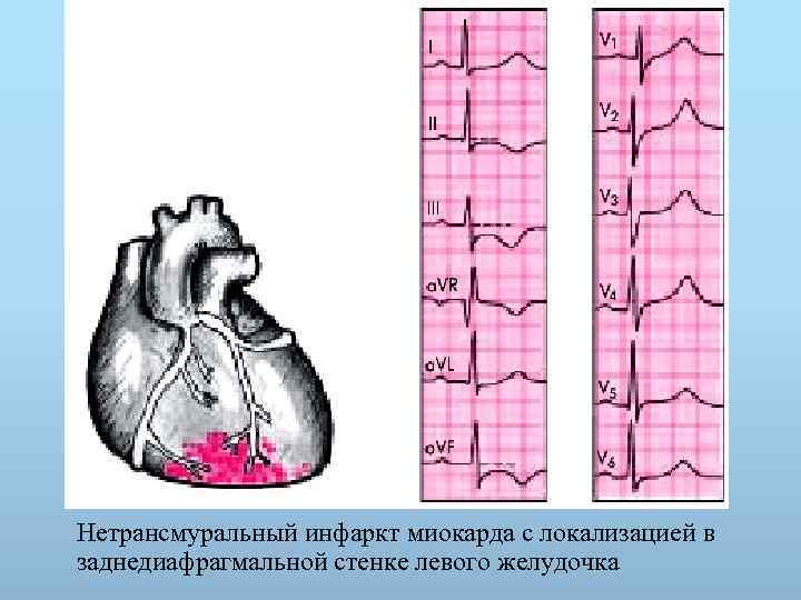 Нетрансмуральный инфаркт миокарда с локализацией в заднедиафрагмальной стенке левого желудочка 