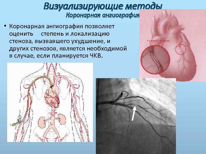 Визуализирующие методы Коронарная ангиография • Коронарная ангиография позволяет оценить степень и локализацию стеноза, вызвавшего