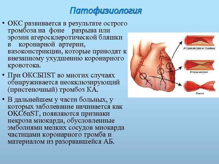 Патофизиология • ОКС развивается в результате острого тромбоза на фоне разрыва или эрозии атеросклеротической