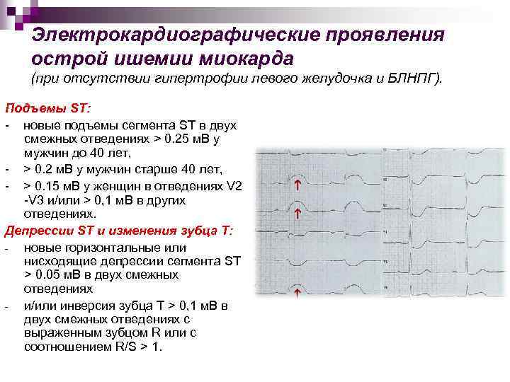 Электрокардиографические проявления острой ишемии миокарда (при отсутствии гипертрофии левого желудочка и БЛНПГ). Подъемы ST: