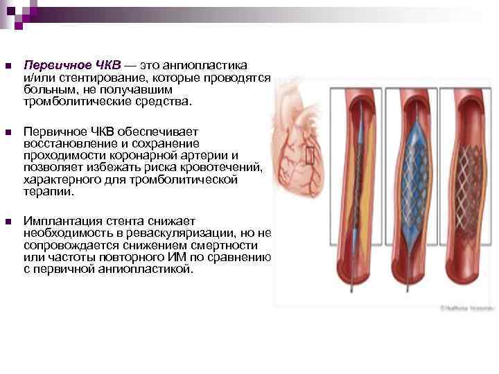 n Первичное ЧКВ — это ангиопластика и/или стентирование, которые проводятся больным, не получавшим тромболитические