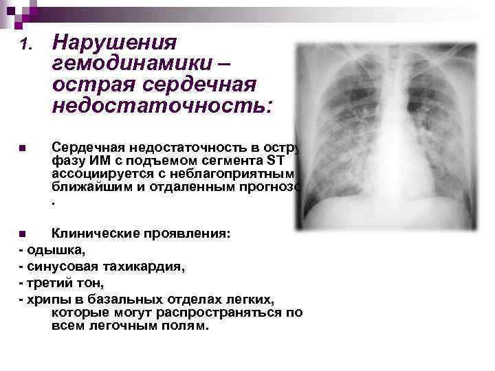 1. Нарушения гемодинамики – острая сердечная недостаточность: n Сердечная недостаточность в острую фазу ИМ