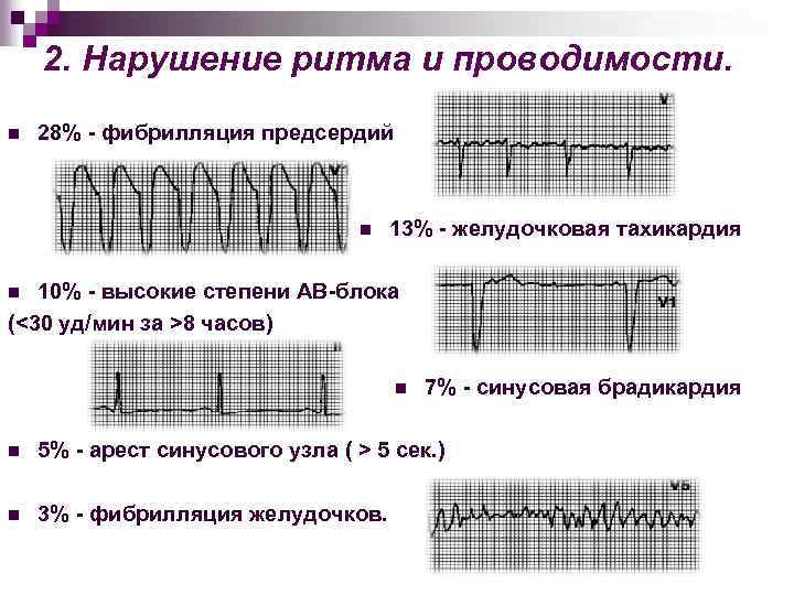 2. Нарушение ритма и проводимости. n 28% - фибрилляция предсердий n 13% - желудочковая
