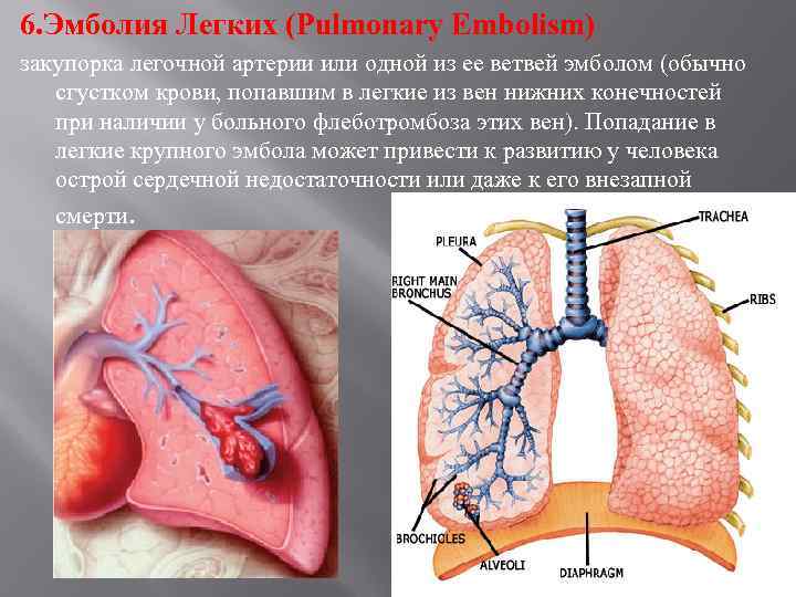 6. Эмболия Легких (Pulmonary Embolism) закупорка легочной артерии или одной из ее ветвей эмболом