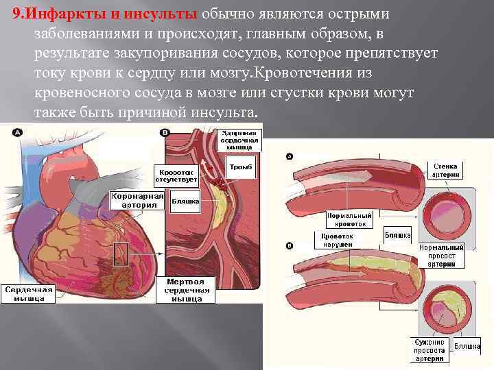 9. Инфаркты и инсульты обычно являются острыми заболеваниями и происходят, главным образом, в результате