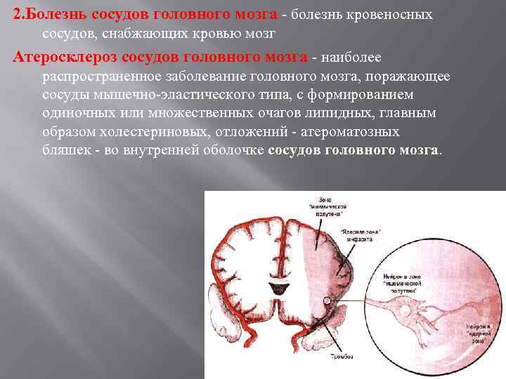 2. Болезнь сосудов головного мозга - болезнь кровеносных сосудов, снабжающих кровью мозг Атеросклероз сосудов