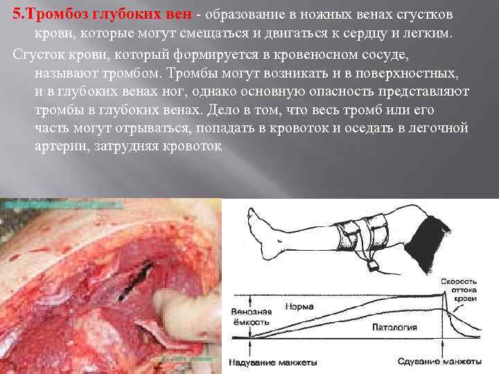 5. Тромбоз глубоких вен - образование в ножных венах сгустков крови, которые могут смещаться