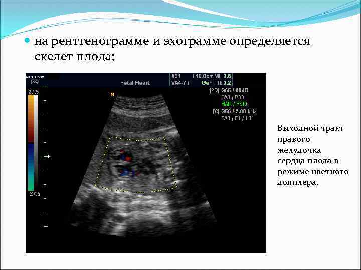  на рентгенограмме и эхограмме определяется скелет плода; Выходной тракт правого желудочка сердца плода