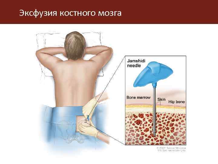 Эксфузия костного мозга 