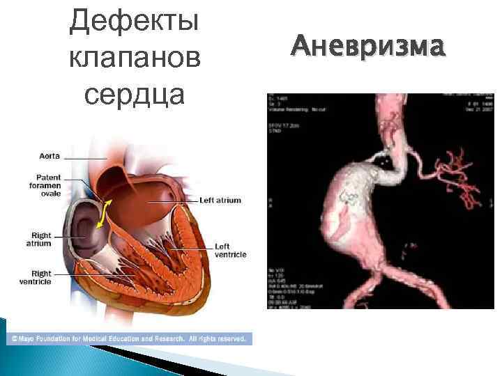 Дефекты клапанов сердца Аневризма 