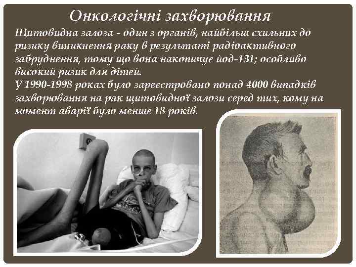 Онкологічні захворювання Щитовидна залоза - один з органів, найбільш схильних до ризику виникнення раку