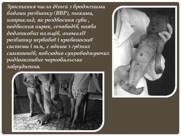 Зростання числа дітей з вродженими вадами розвитку (ВВР), такими, наприклад, як роздвоєння губи ,