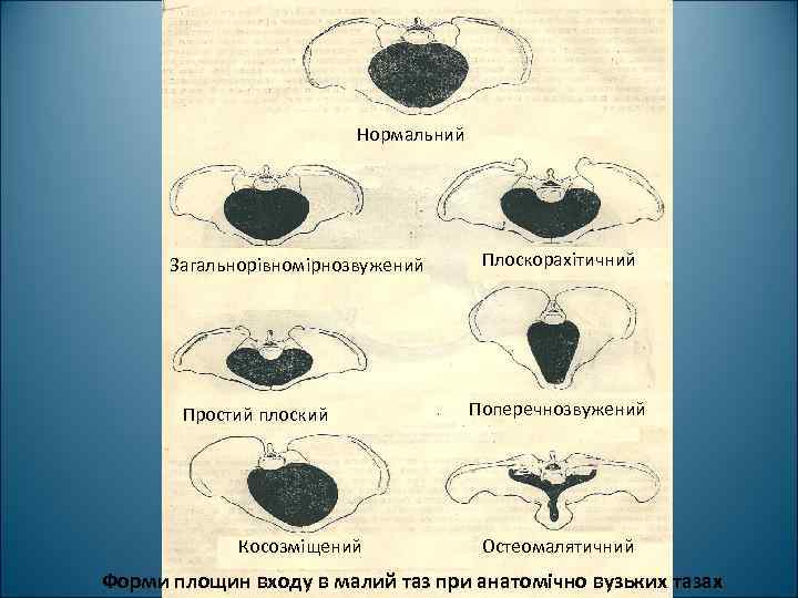 Нормальний Загальнорівномірнозвужений Простий плоский Косозміщений Плоскорахітичний Поперечнозвужений Остеомалятичний Форми площин входу в малий таз