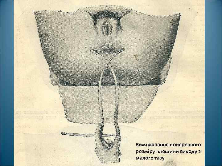 Вимірювання поперечного розміру площини виходу з малого тазу 