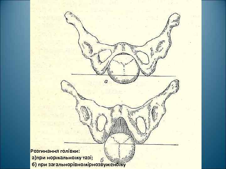 Розгинання голівки: а)при нормальному тазі; б) при загальнорівномірнозвуженому 
