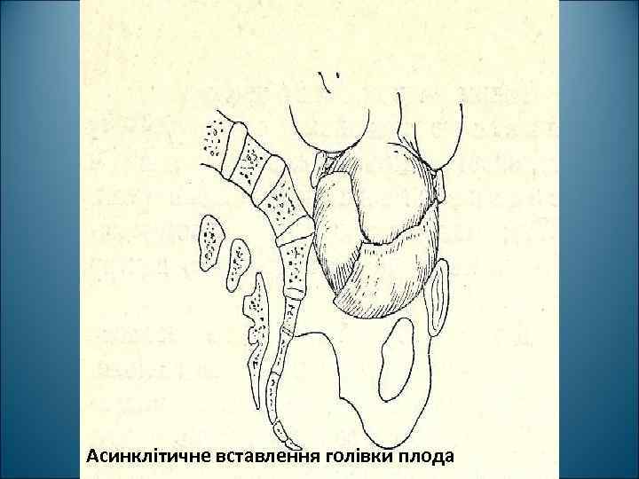 Асинклітичне вставлення голівки плода 